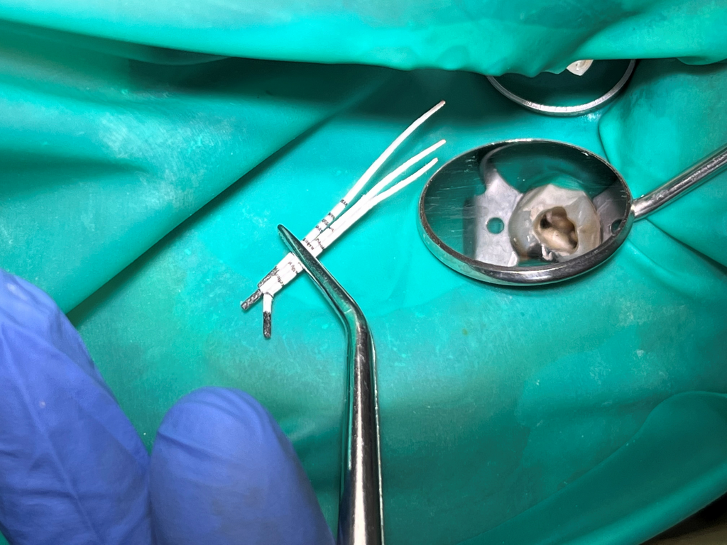 Come appare il trattamento moderno dei canali radicolari?