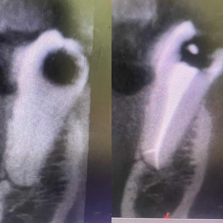 Come appare il trattamento moderno dei canali radicolari?